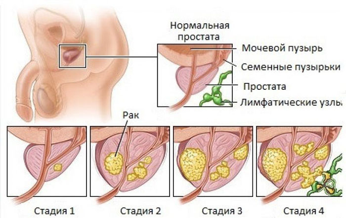 Рак простаты